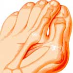 Bunions